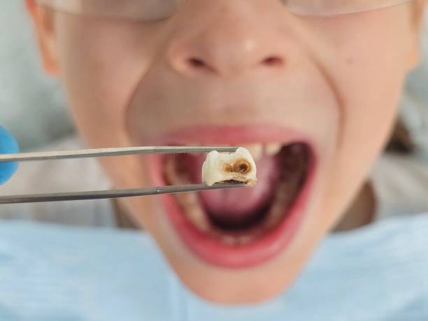 Best Dentist for Tooth Abscess  in West Dennis, MA